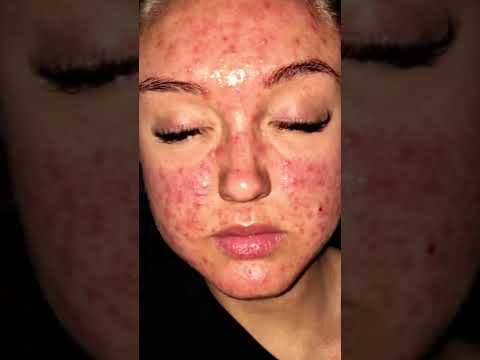 1 product that changed my life 😱🤩❤️ #shorts #acne #skincare